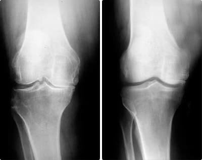Joint recovery documentation for marathon runner