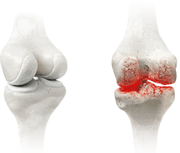 Scientific diagram showing cartilage protection under physical load
